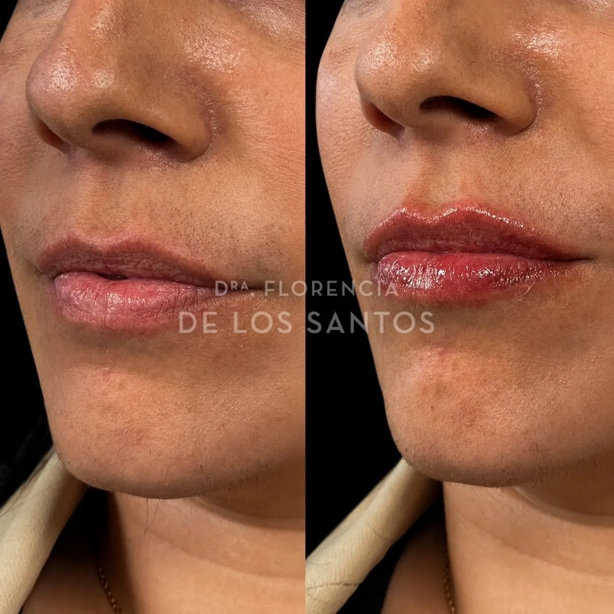 Relleno hidratacion labios Dra Florencia de los Santos Medicliniq4