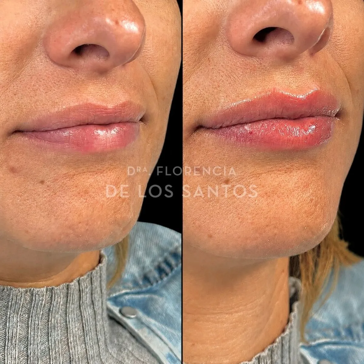 Relleno hidratacion labios Dra Florencia de los Santos Medicliniq5