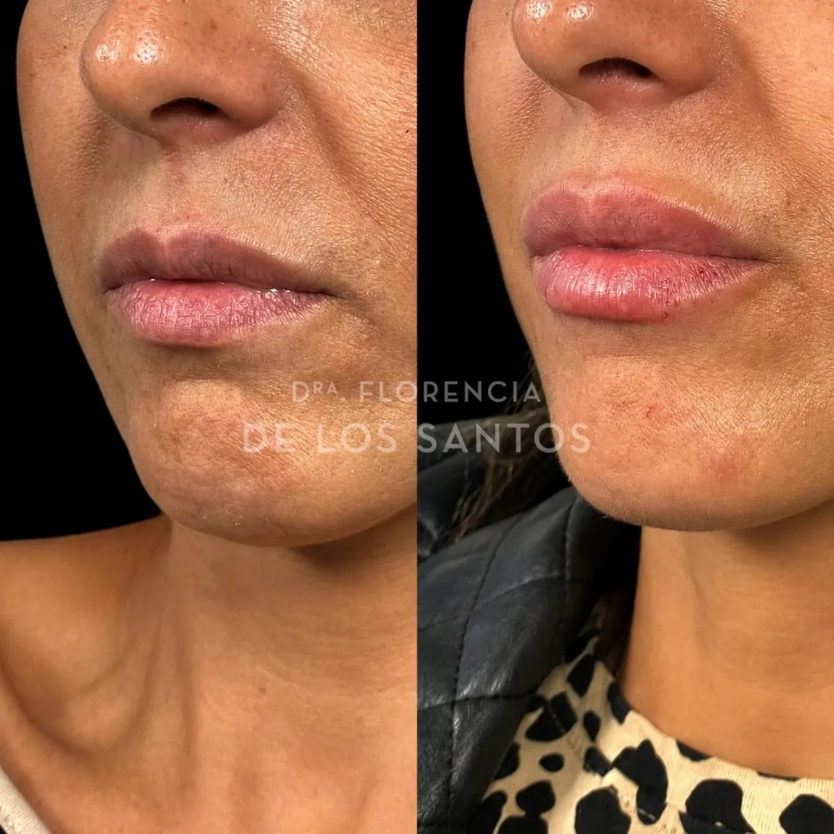 Relleno hidratacion labios Dra Florencia de los Santos Medicliniq6