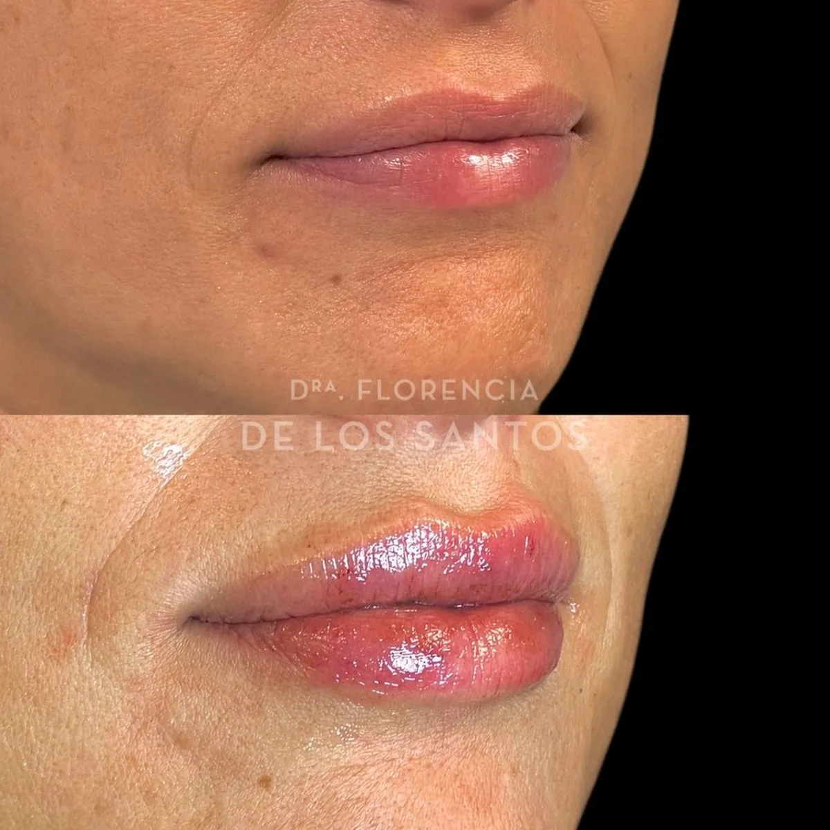 Relleno hidratacion labios Dra Florencia de los Santos Medicliniq7