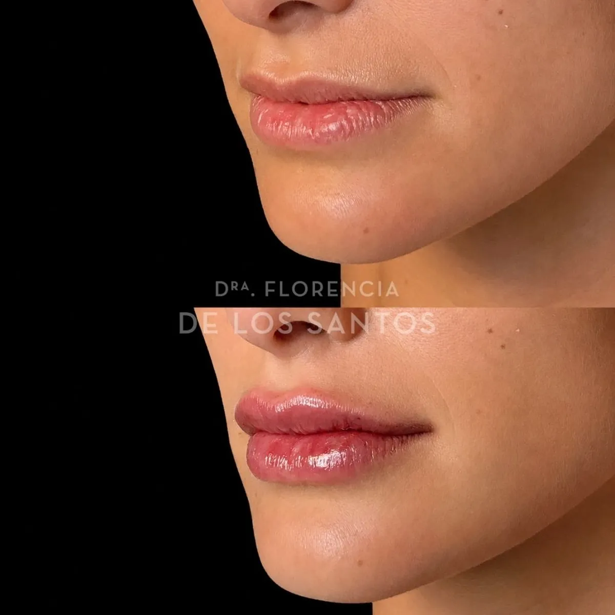 Relleno hidratacion labios Dra Florencia de los Santos Medicliniq8