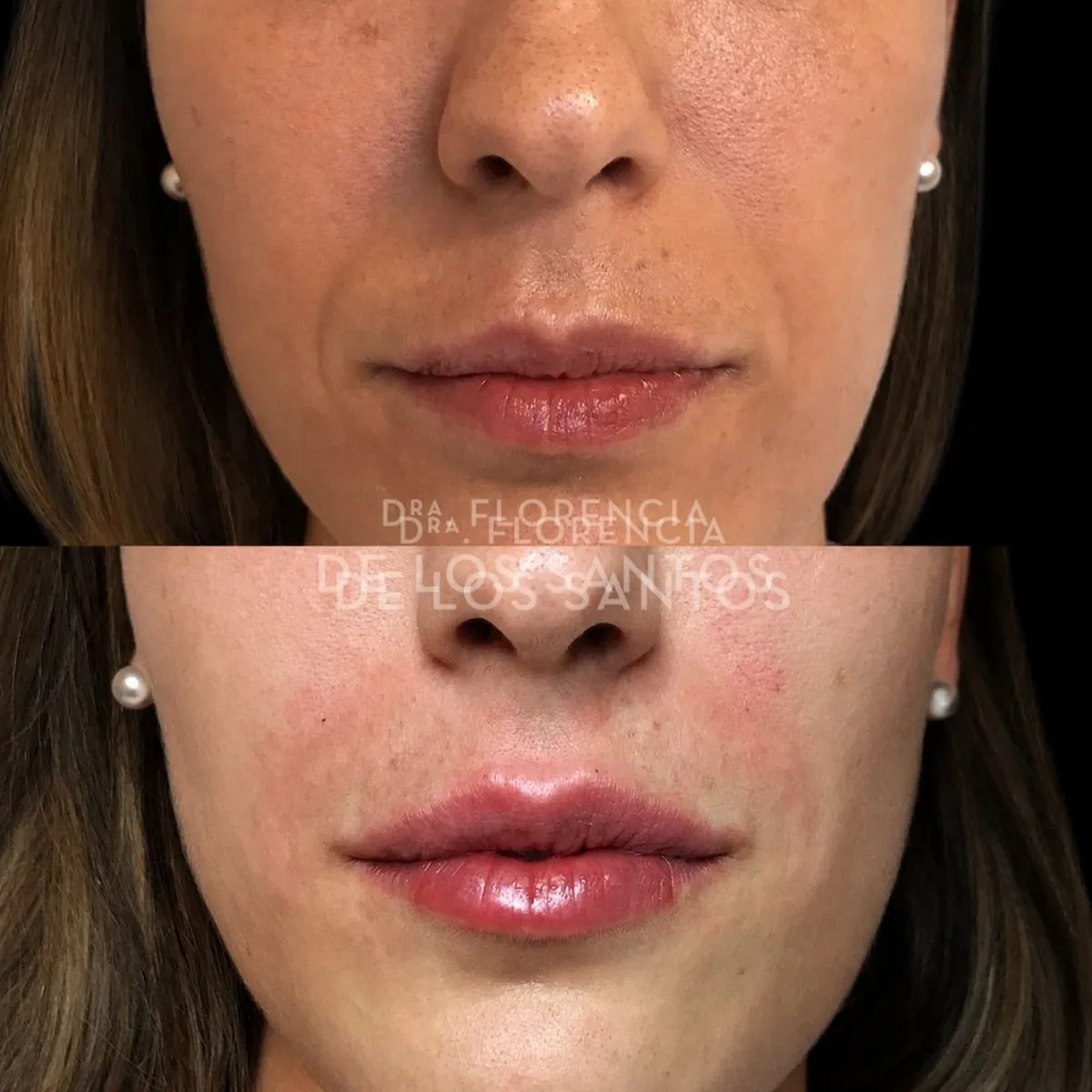 Relleno hidratacion labios Dra Florencia de los Santos Medicliniq9