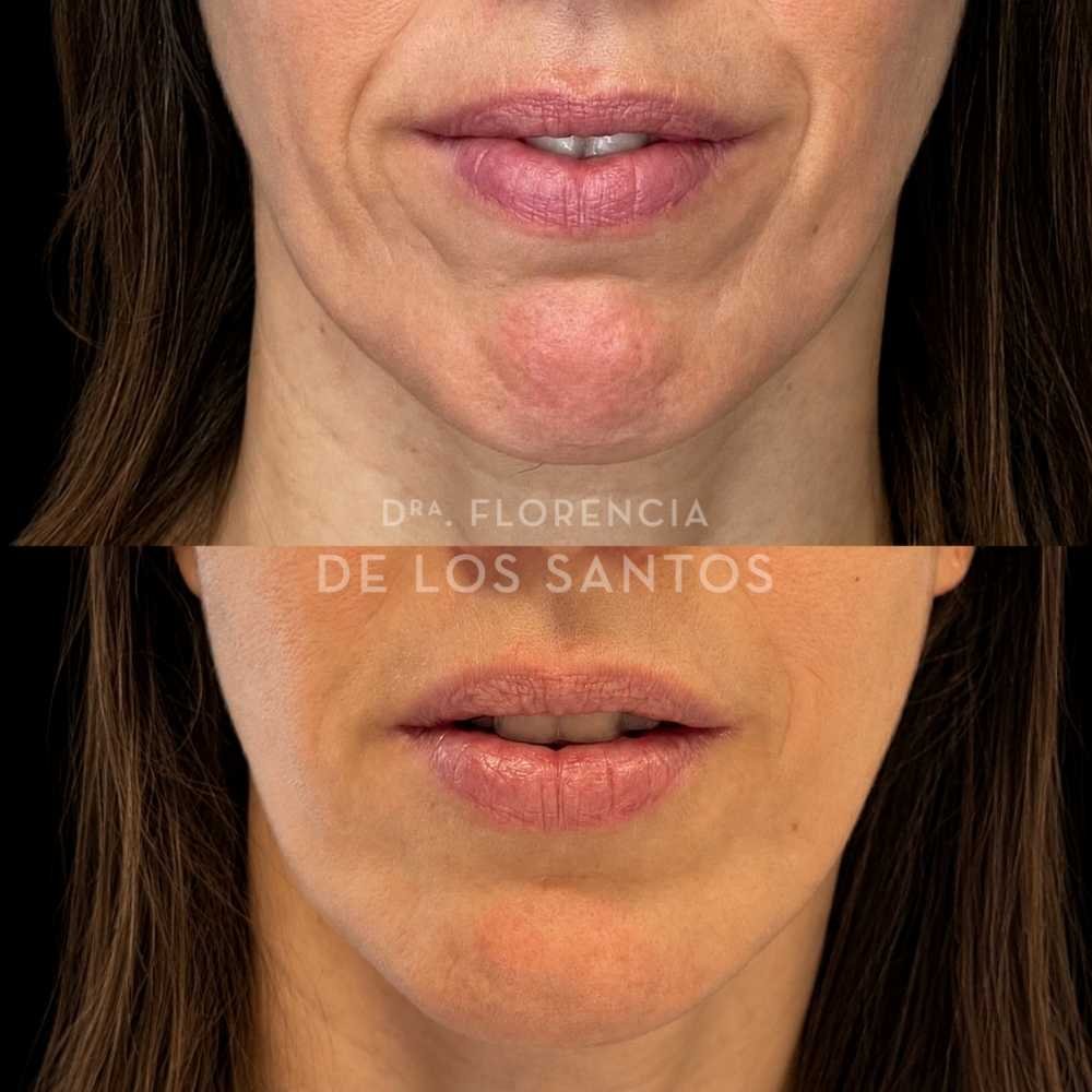 Relleno surcos y marionetas Dra Florencia de los Santos Medicliniq4