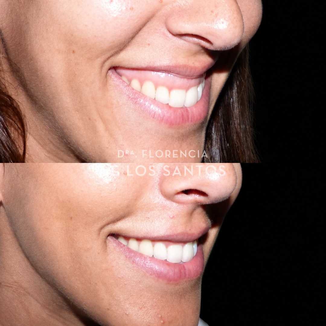 Sonrisa gingival medicliniq montevideo