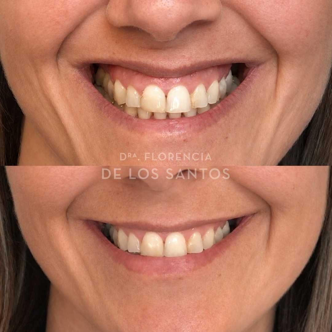 Sonrisa gingival botox dra florencia de los santos medicliniq1