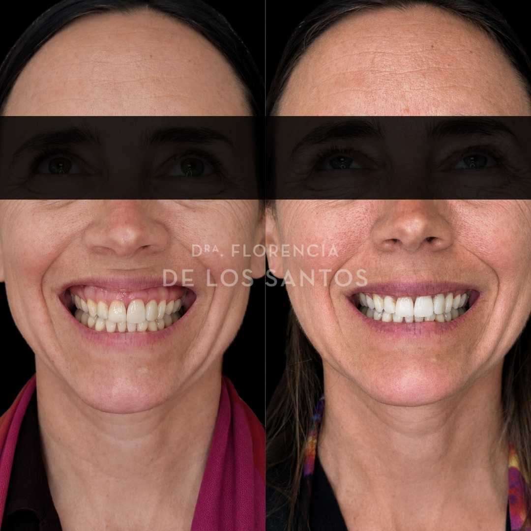 Sonrisa gingival botox dra florencia de los santos medicliniq2