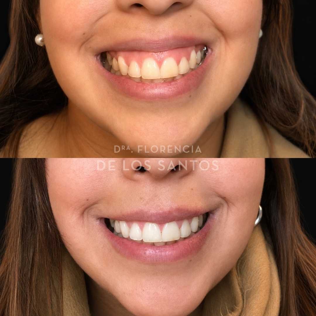 Sonrisa gingival botox dra florencia de los santos medicliniq3