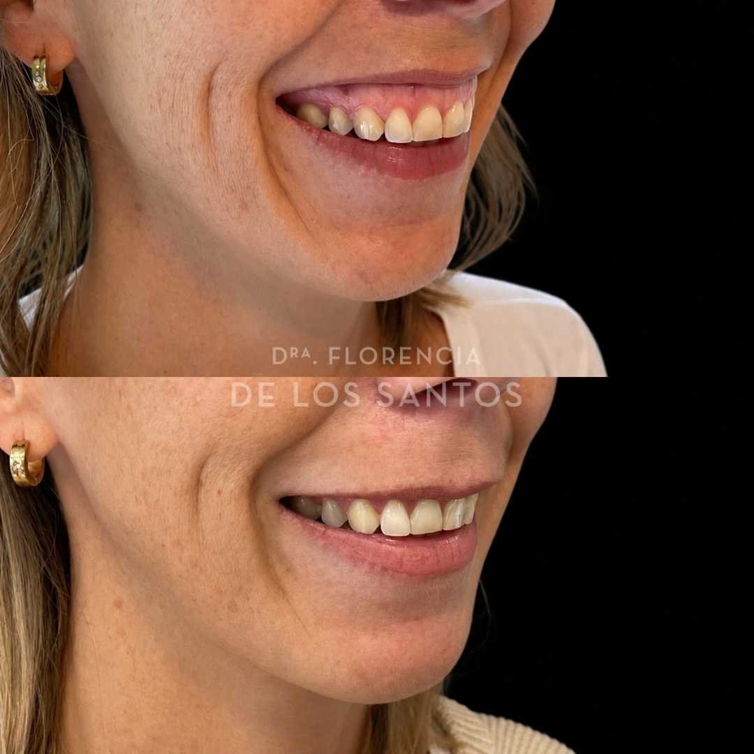 Sonrisa gingival botox dra florencia de los santos medicliniq4