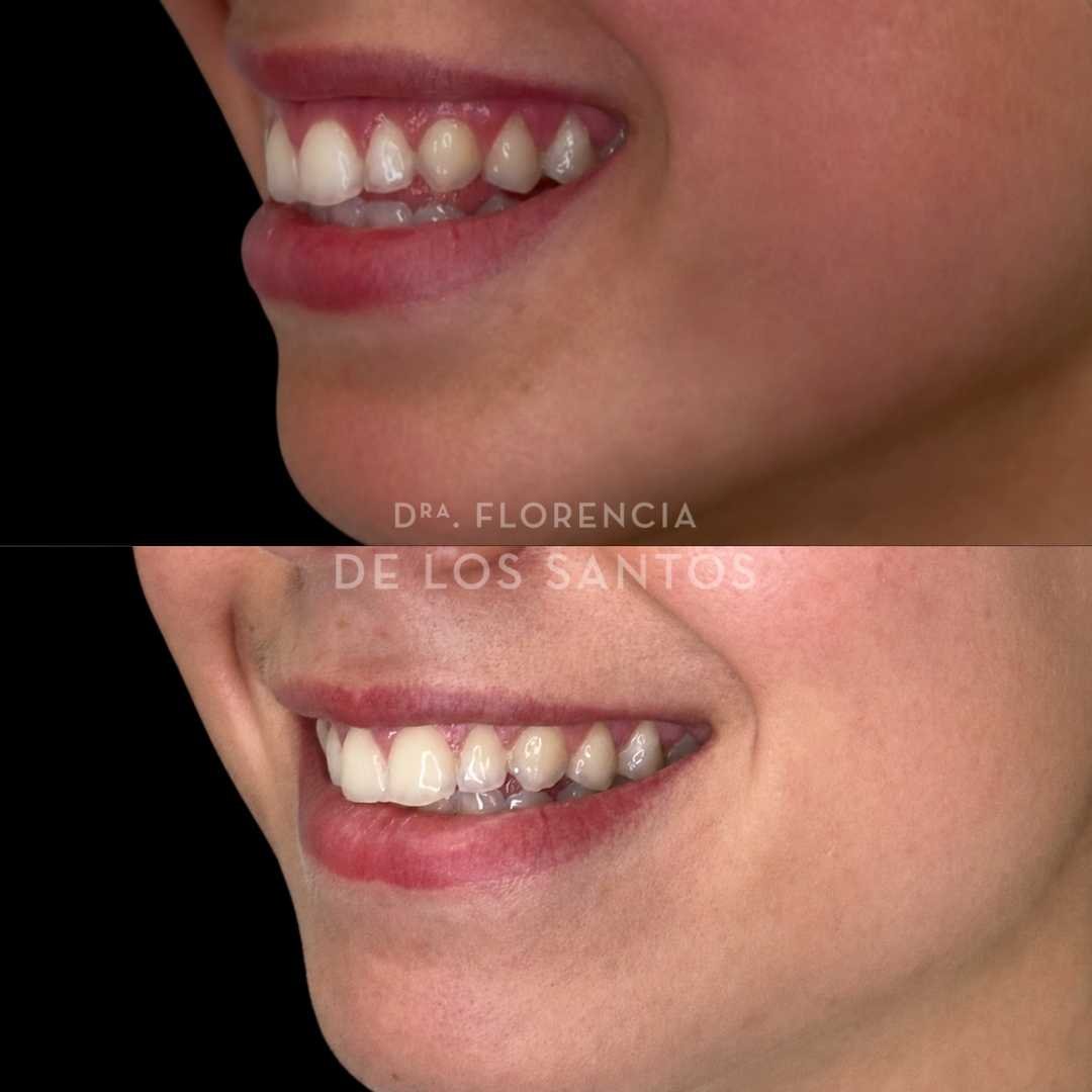 Sonrisa gingival botox dra florencia de los santos medicliniq5