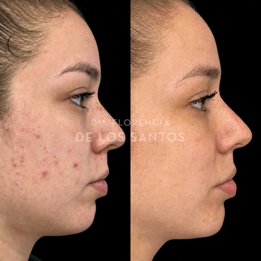 acné dra florencia de los santos tecnologia laser e ipl medicliniq5