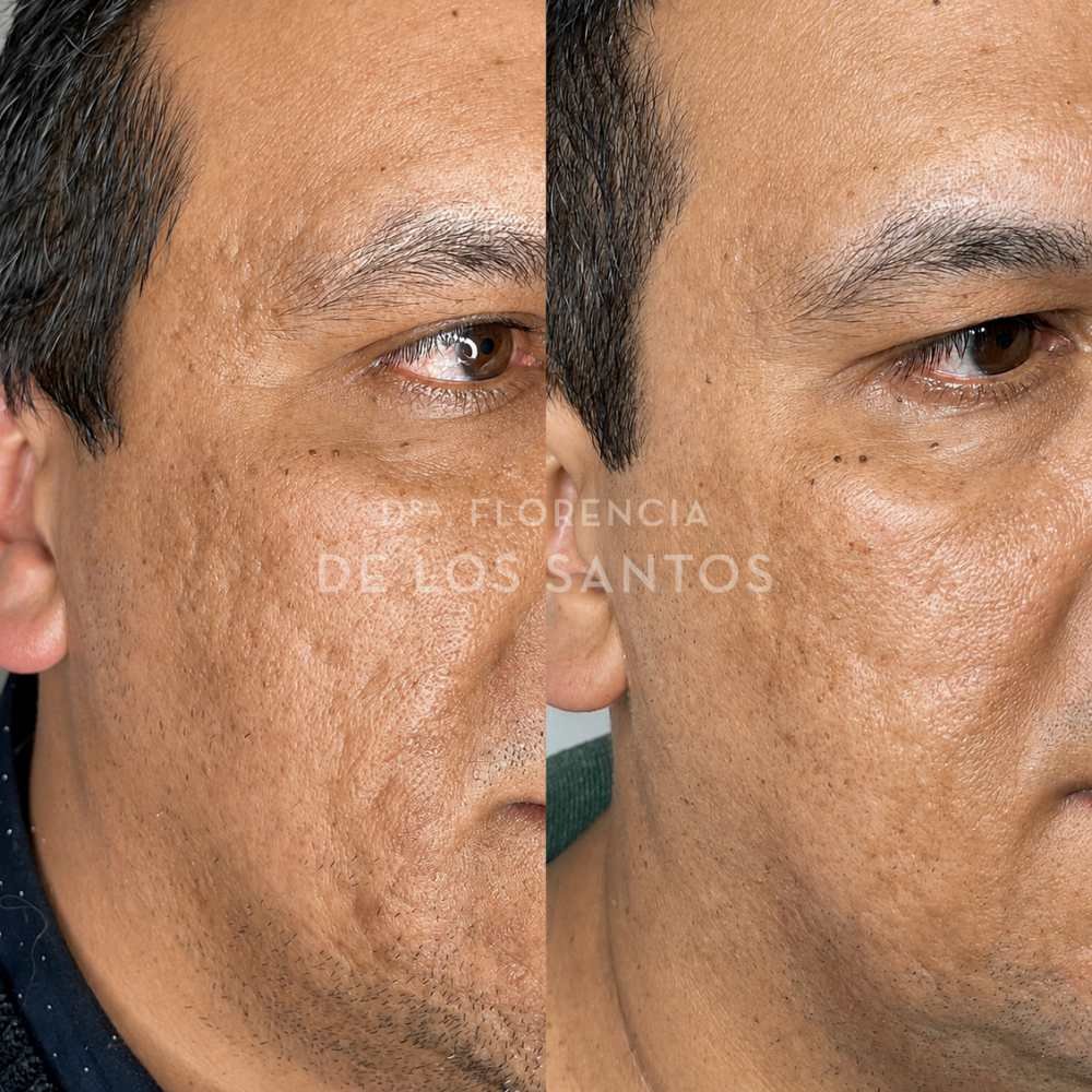 cicatriz laser dra florencia de los santos medicliniq1