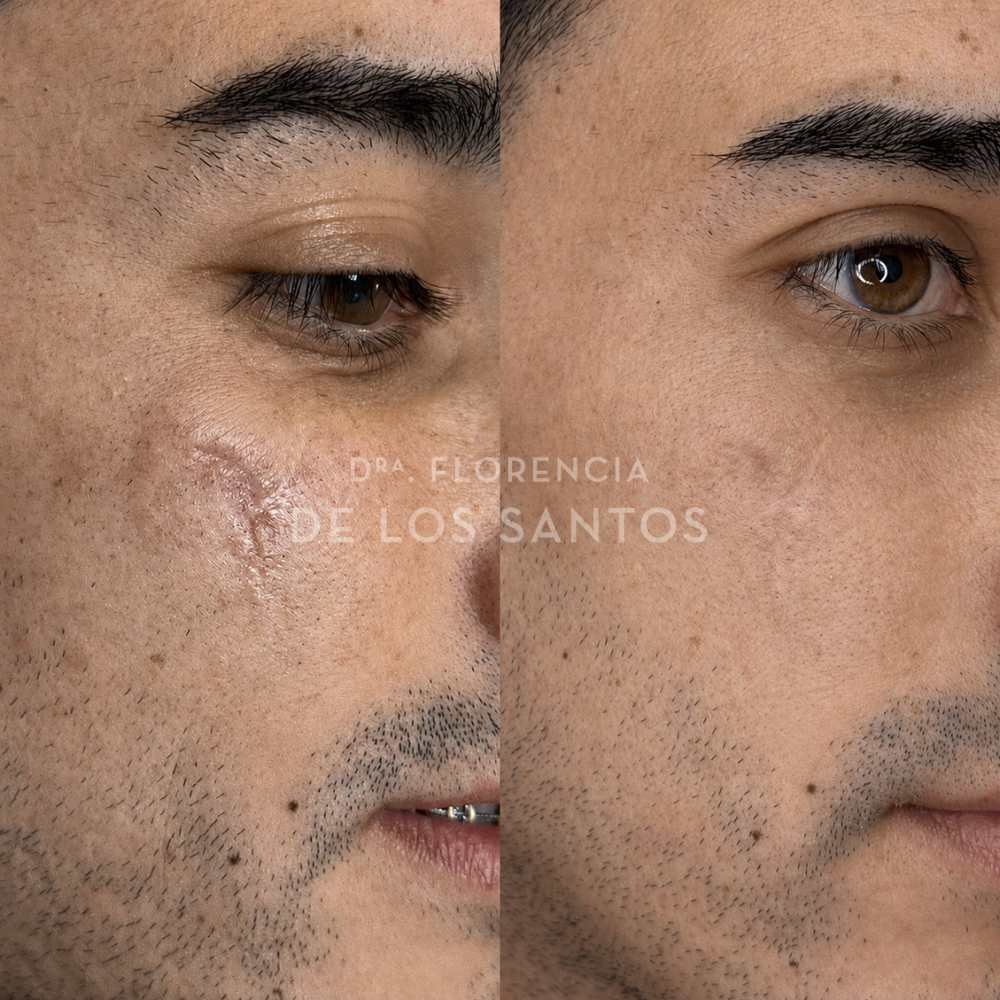 cicatriz laser dra florencia de los santos medicliniq2