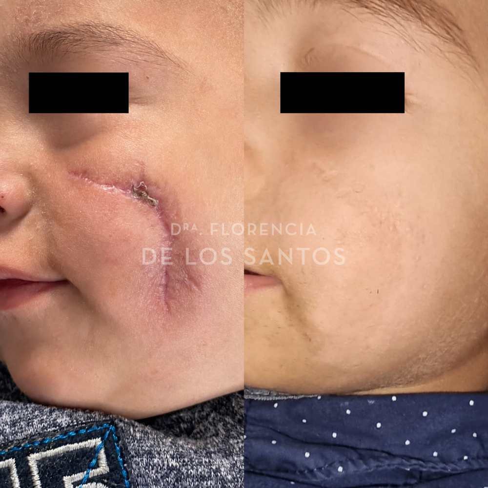 cicatriz laser dra florencia de los santos medicliniq3