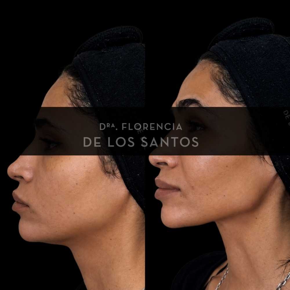 dra florencia de los santos medicliniq montevideo marcacion mandibular42