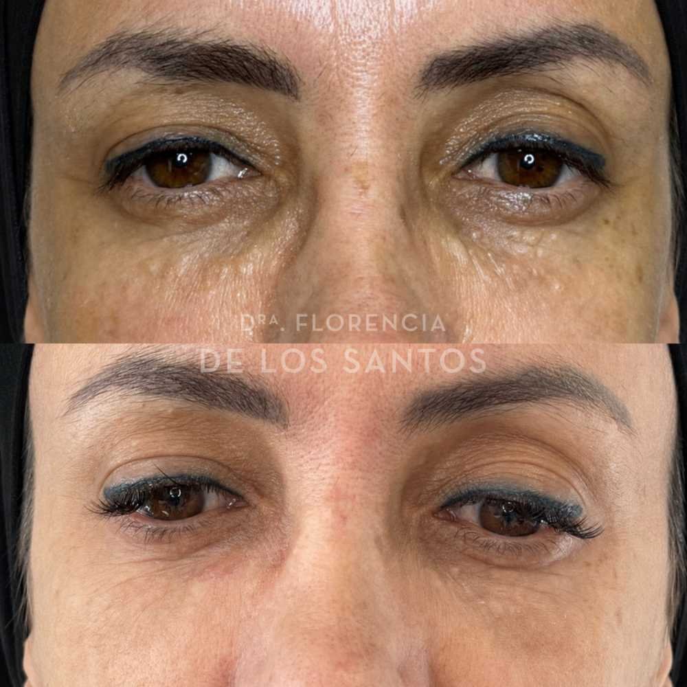 lesiones benignas de piel dra florencia de los santos medicliniq montevideo marcacion mandibular10