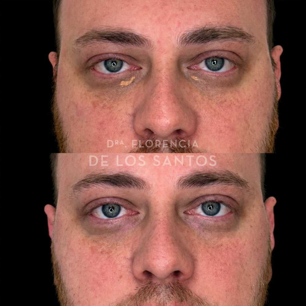 lesiones benignas de piel dra florencia de los santos medicliniq montevideo marcacion mandibular11
