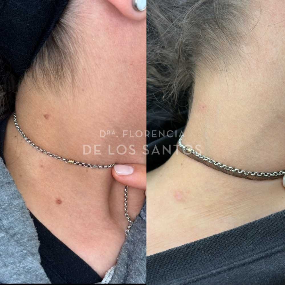 lesiones benignas de piel dra florencia de los santos medicliniq montevideo marcacion mandibular8