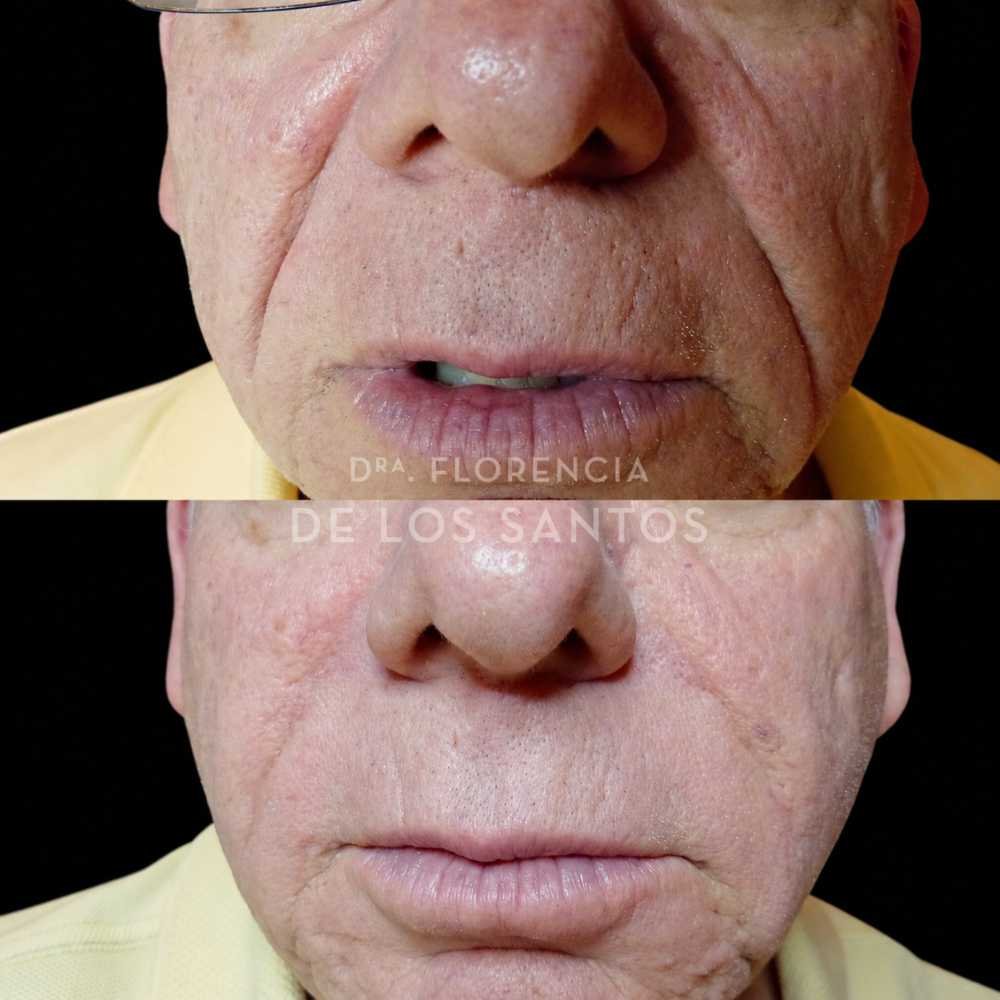 rellenos de surcos dra florencia de los santos tecnologia laser e ipl medicliniq7