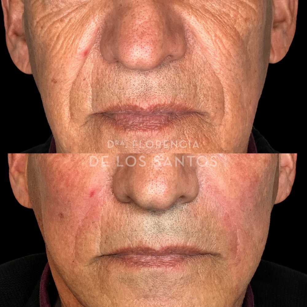 rellenos de surcos dra florencia de los santos tecnologia laser e ipl medicliniq8